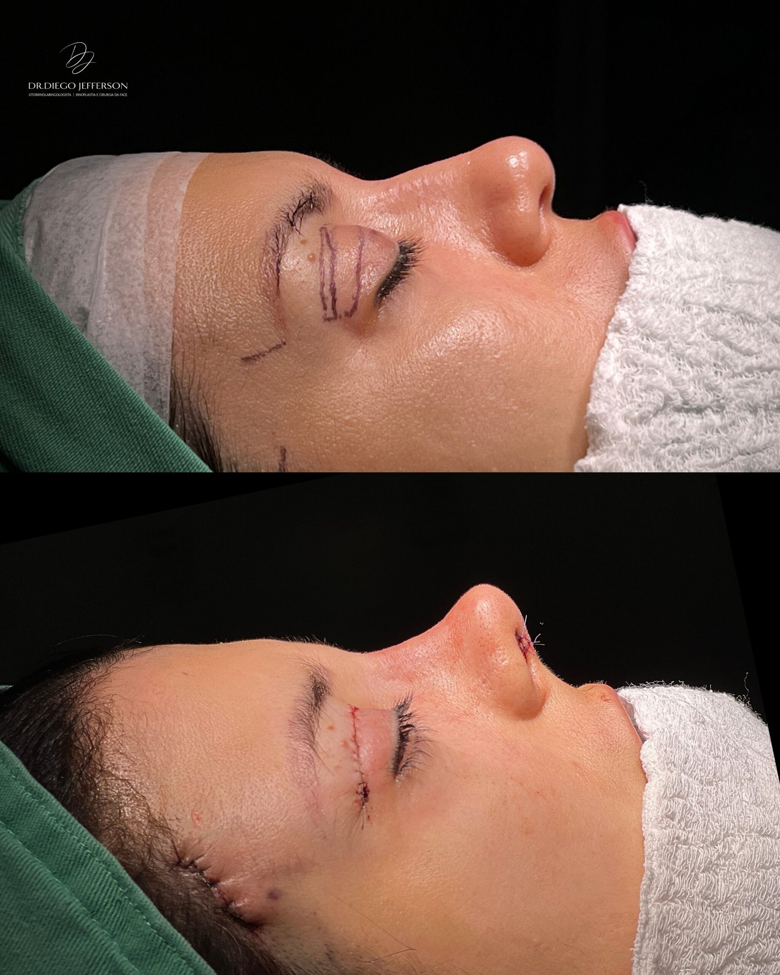 rinoplastia personalizada em Teresina